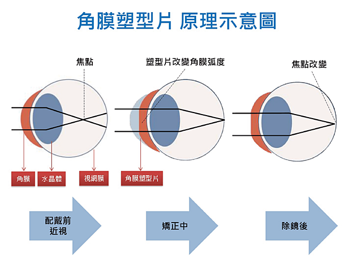 EyePlus聚英視光眼科，角膜塑型片推薦EyePlus，矯正「惡」視力，夜晚配戴，還你白天好視力！ @捲捲頭 ♡ 品味生活